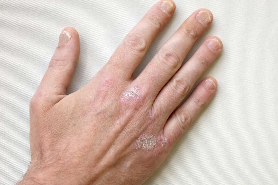 Treatment of psoriasis on the hands of men with Keramin cream
