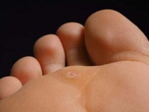 Causes of nipple plant