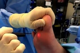 Surgical methods of removing nipples