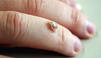 Methods for treating warts with a member