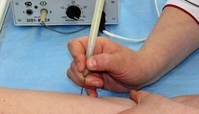 How to get rid of papillomes on your body