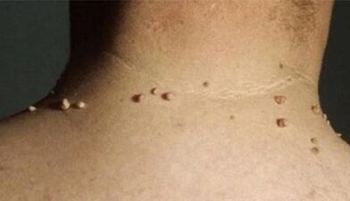 The reasons looks like a papillom on the human body