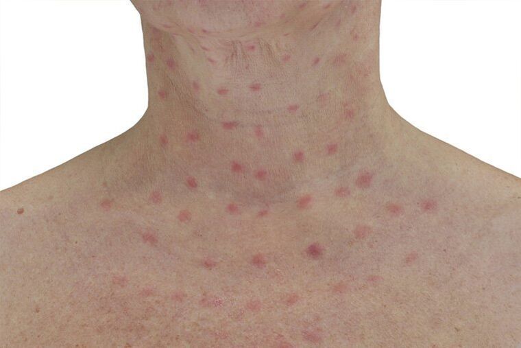 Skin after electrocoagulation