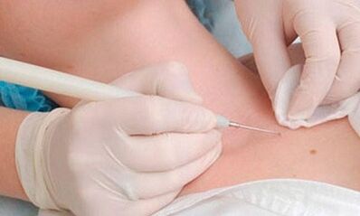 Methods of removing the papillom on the neck