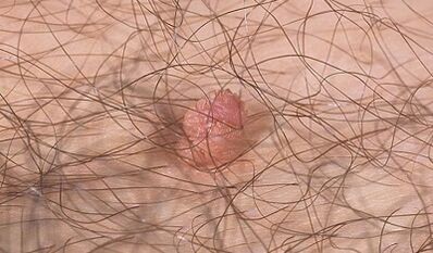 Ways of transmission of the virus of the human papillo