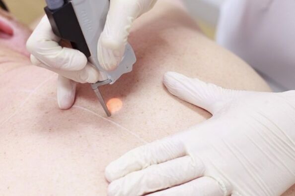 A popular method for laser papilloma removal