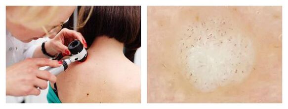 Dermatoscopy of the nipple