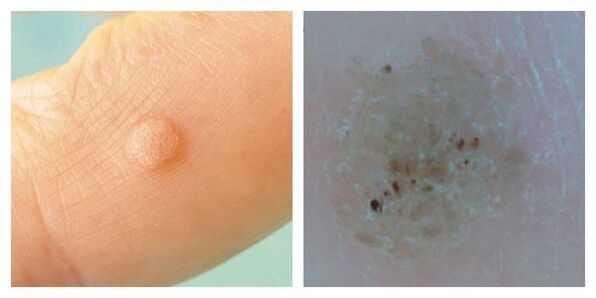 Ordinary nipple during interrogation and dermatoscopy