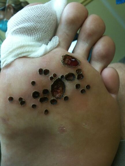 Skin after laser removal of nipples on the leg