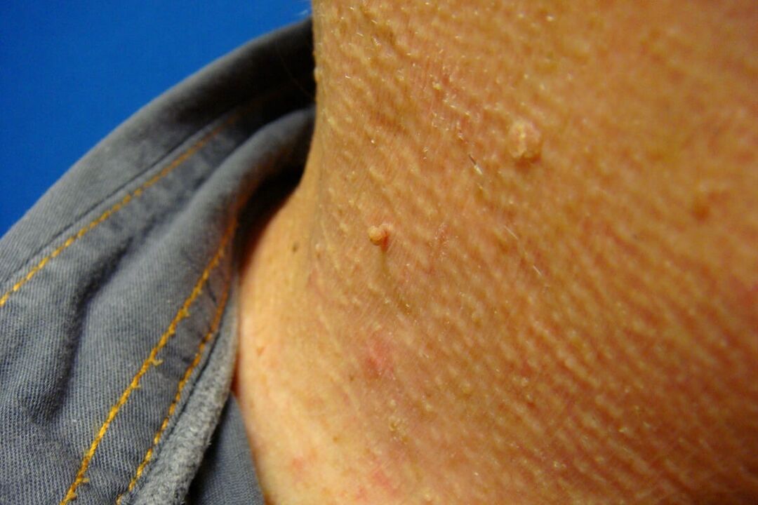 papilloma on the human neck